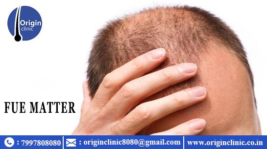 Fue Hair Transplant in Hyderabad | Hair Loss Treatment for Women
